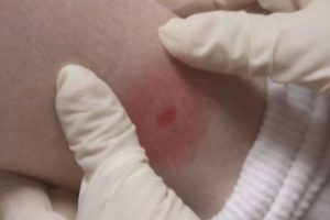 This is the bullseye rash that is commonly associated with Lyme Disease, since many patients find this shape somewhere on their body. “I didn’t find the tick bite,” Kotelly stated. Not all cases are found with a bullseye, which makes it even harder than it already is to determine if someone has the disease.
